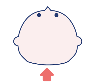 短頭症